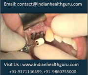 Travel to India for Best Affordable Dental Implants